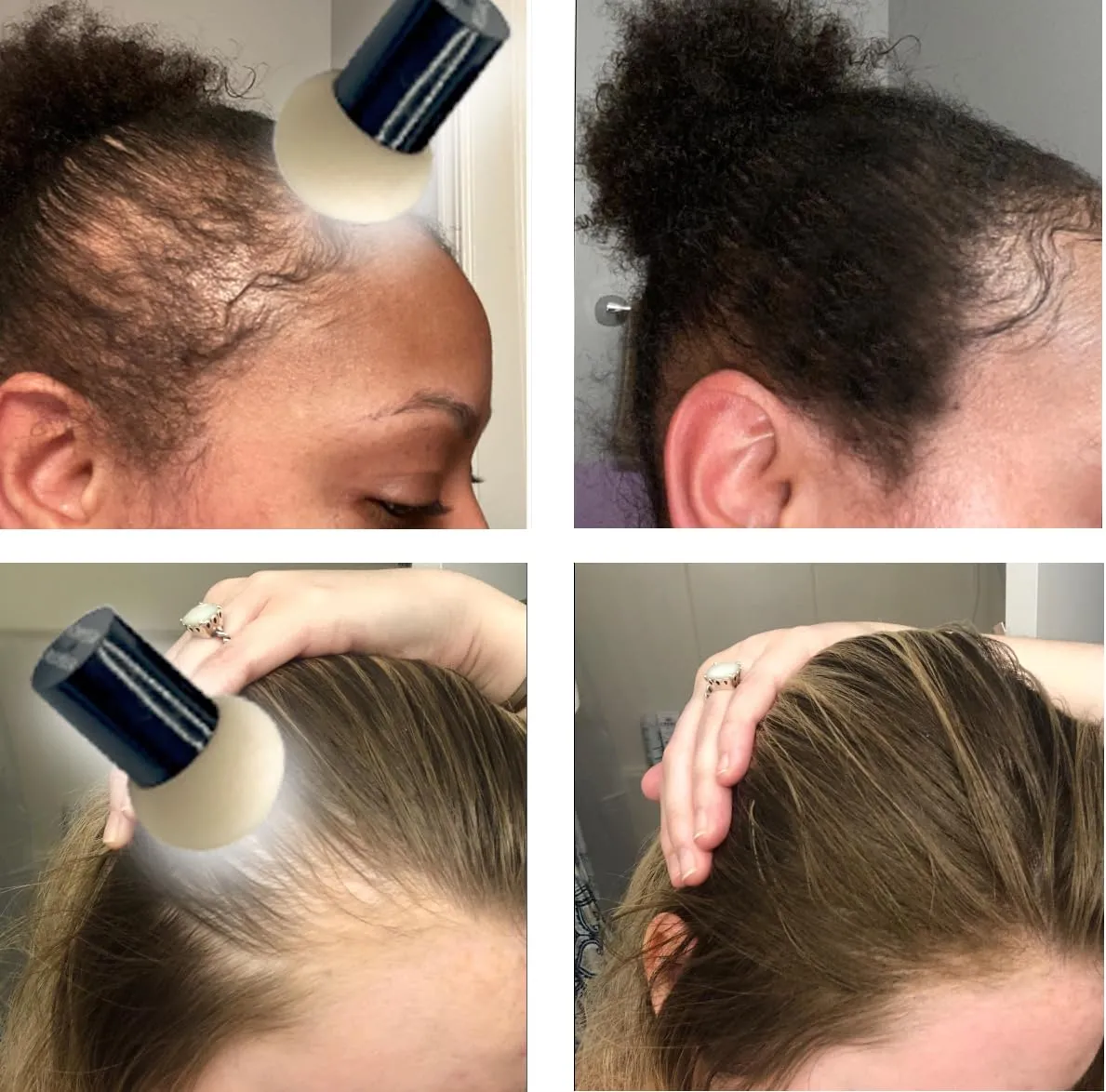 KERATIN RESEARCH Hairline Filler Unisex Mineral Powder Root Touch-Up Hair loss Concealer Scalp & Beard Bald Patch Coverage Fibers for Thinning Hair Waterproof Organic Natural look (BLACK, XL)